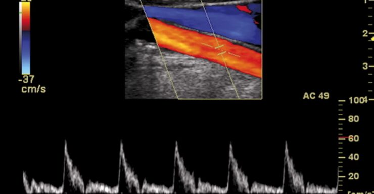 Ecodoppler Artero-Venoso Arti